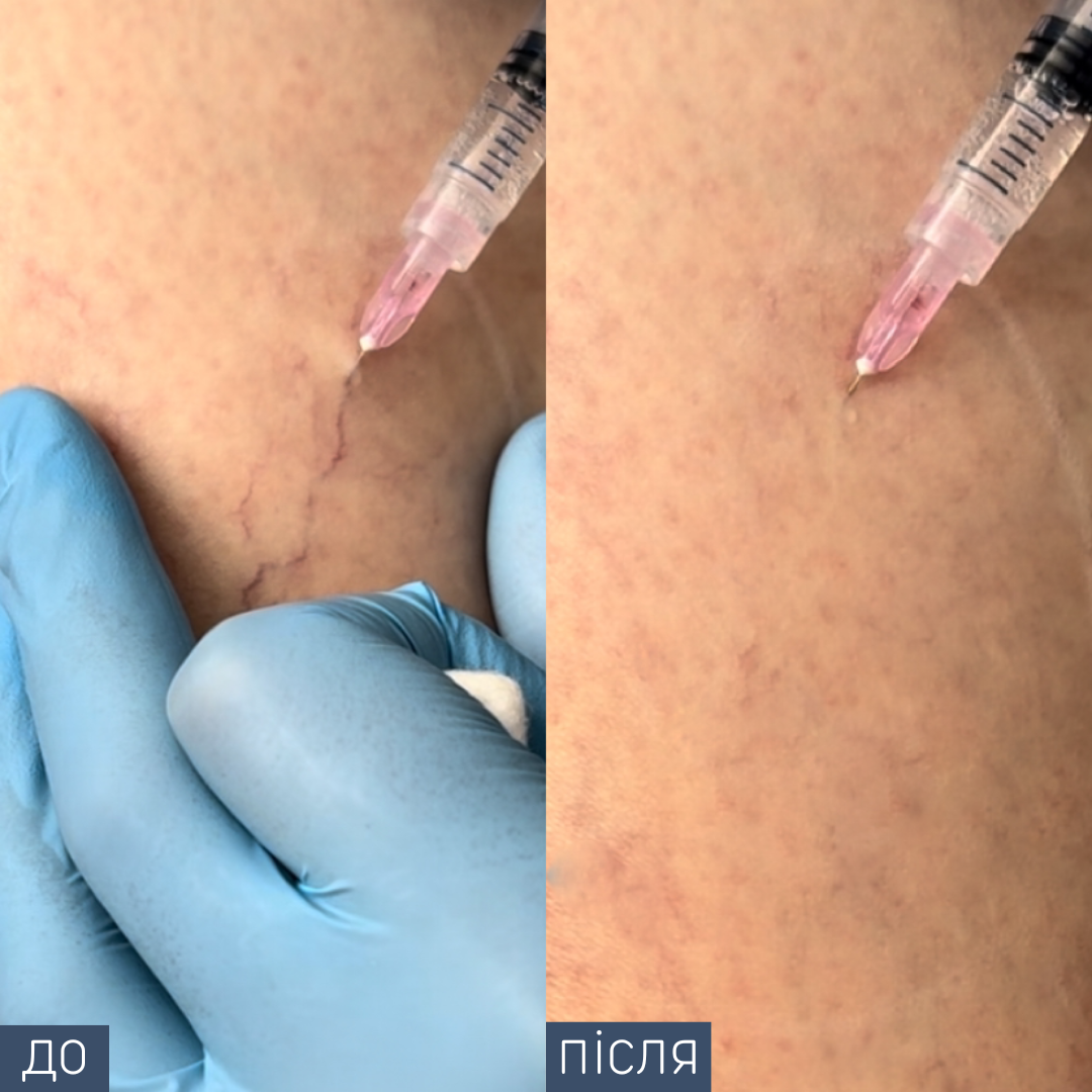 Лікар-хірург Склеротерапія одна процедура 2,5 мл