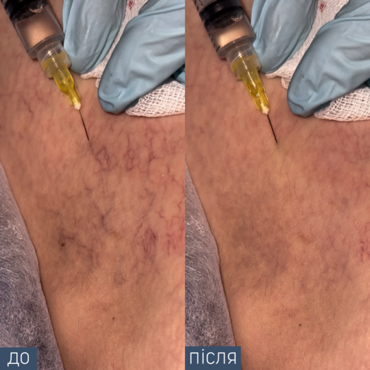 Лікар-хірург Склеротерапія одна процедура 2,5 мл