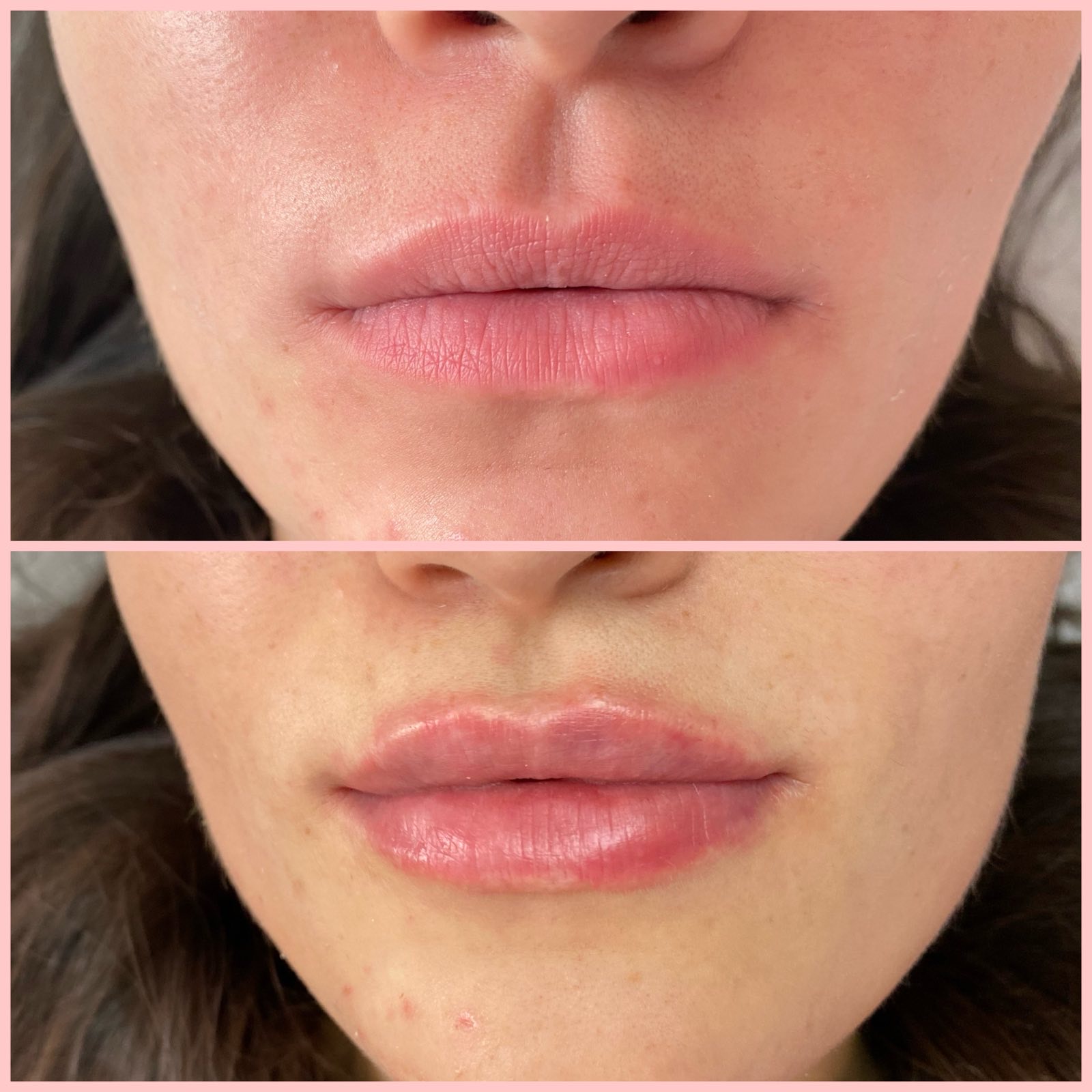 Процедура: Контурная пластика губ Препарат: Restylane Kysse Lidocaine, 1 мл Врач: Оксана Самотос