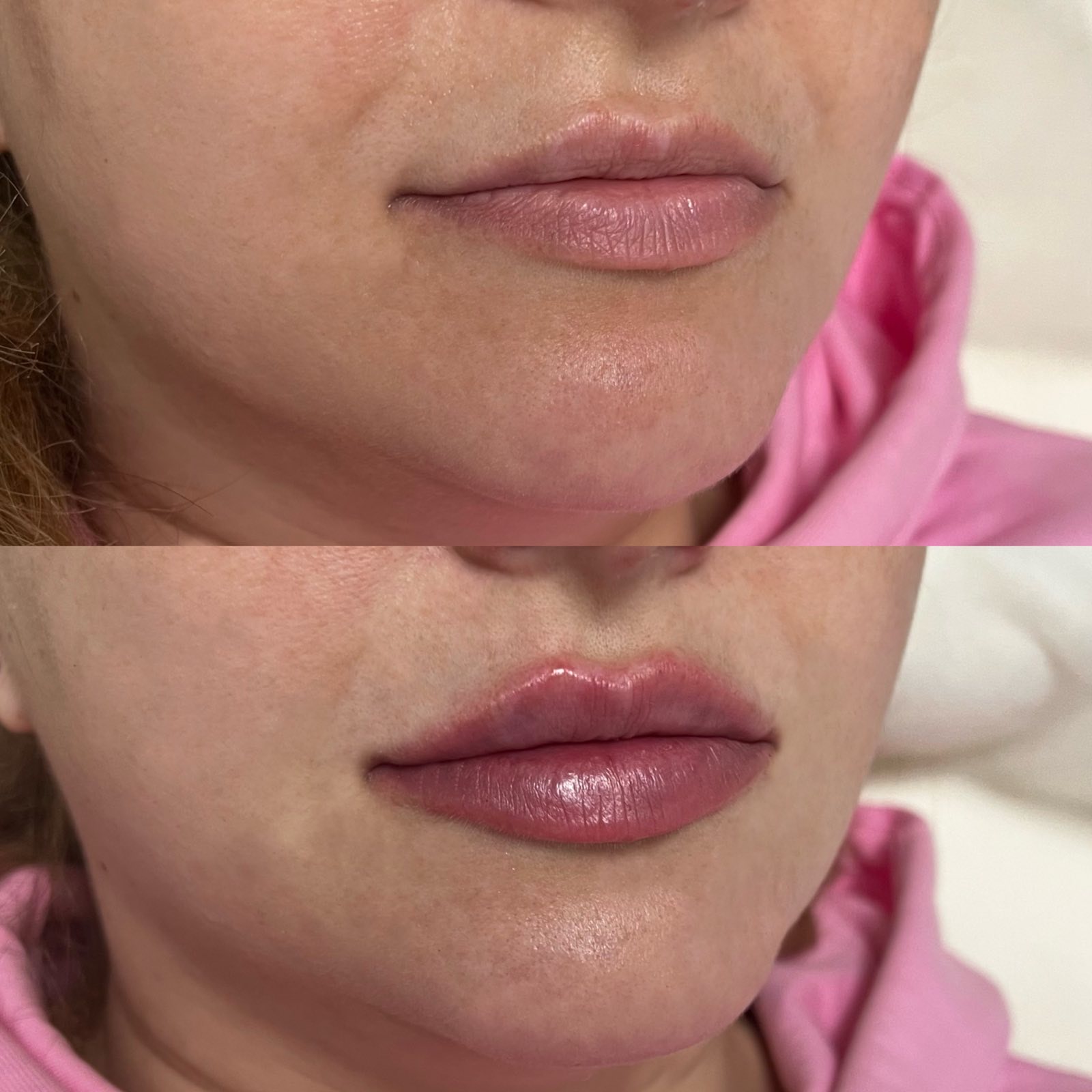 Процедура: Контурная пластика губ Препарат: Hyalual Alexa Medium, 1,0 мл Врач: Александра Гугусь