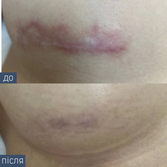 Процедура: Лазерная шлифовка Количество процедур: 3 Врач: Збирко Виктория