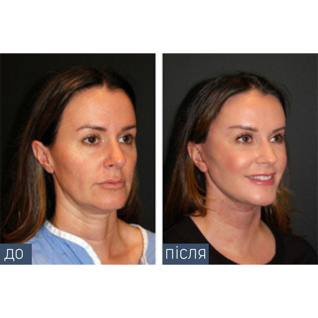 Ділянка: все обличчя + підборіддя Кількість процедур: 1