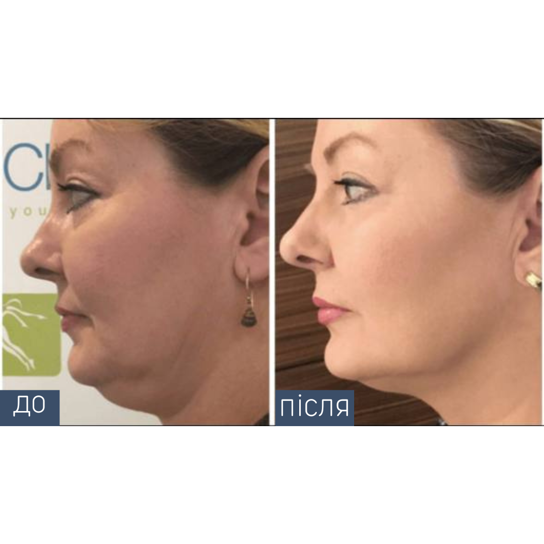 Ділянка: все обличчя + підборіддя Кількість процедур: 1