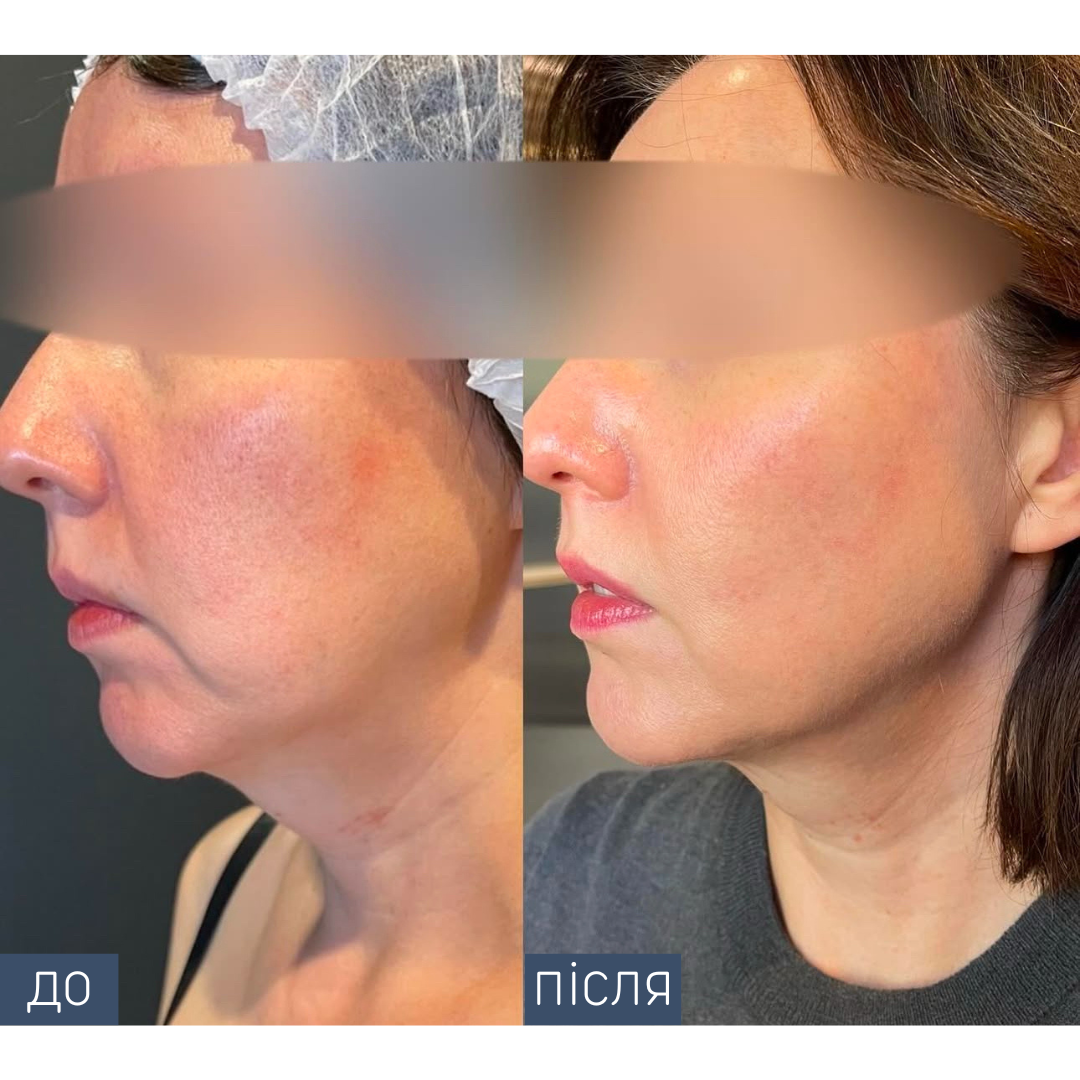 Ділянка: обличчя Кількість процедур: 2
