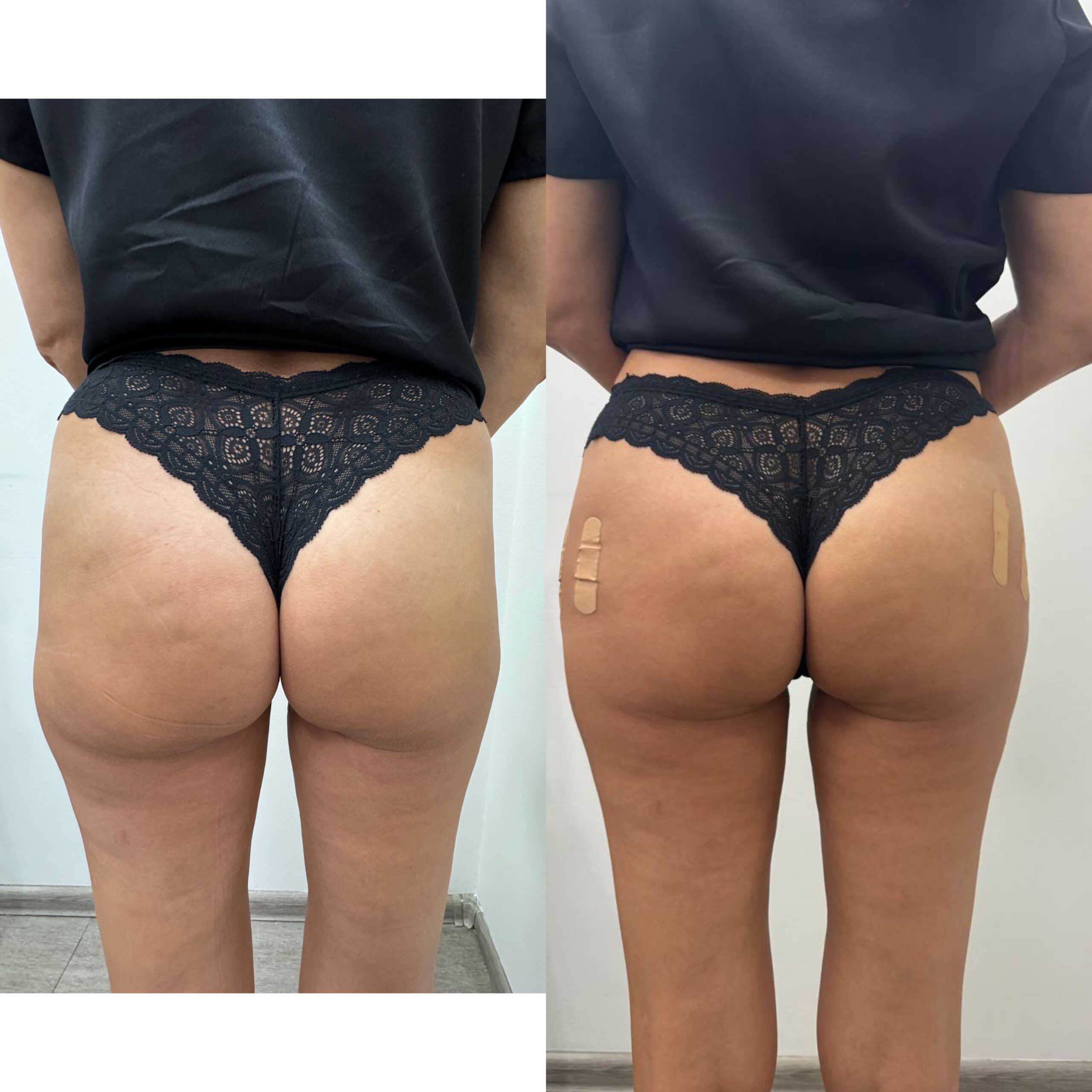 Врач: Самотос Оксана Процедура: пластика ягодиц Препарат: Полимолочная кислота Gana V 15 мл Количество процедур: 1