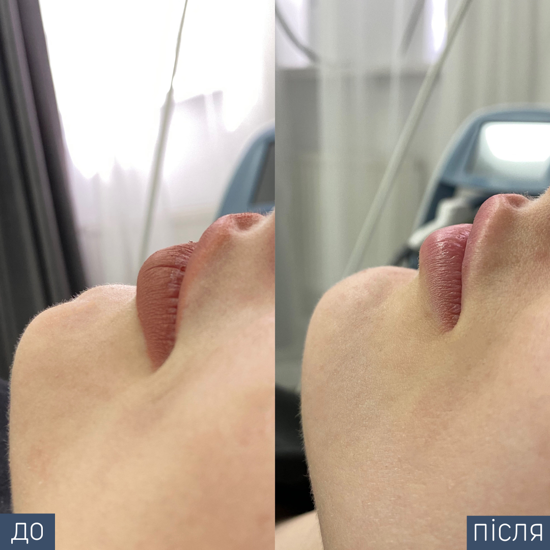 Процедура: Контурная пластика подбородка Препарат: Hуalual Alexa Volume, 1,0 мл Врач: Оксана Самотос