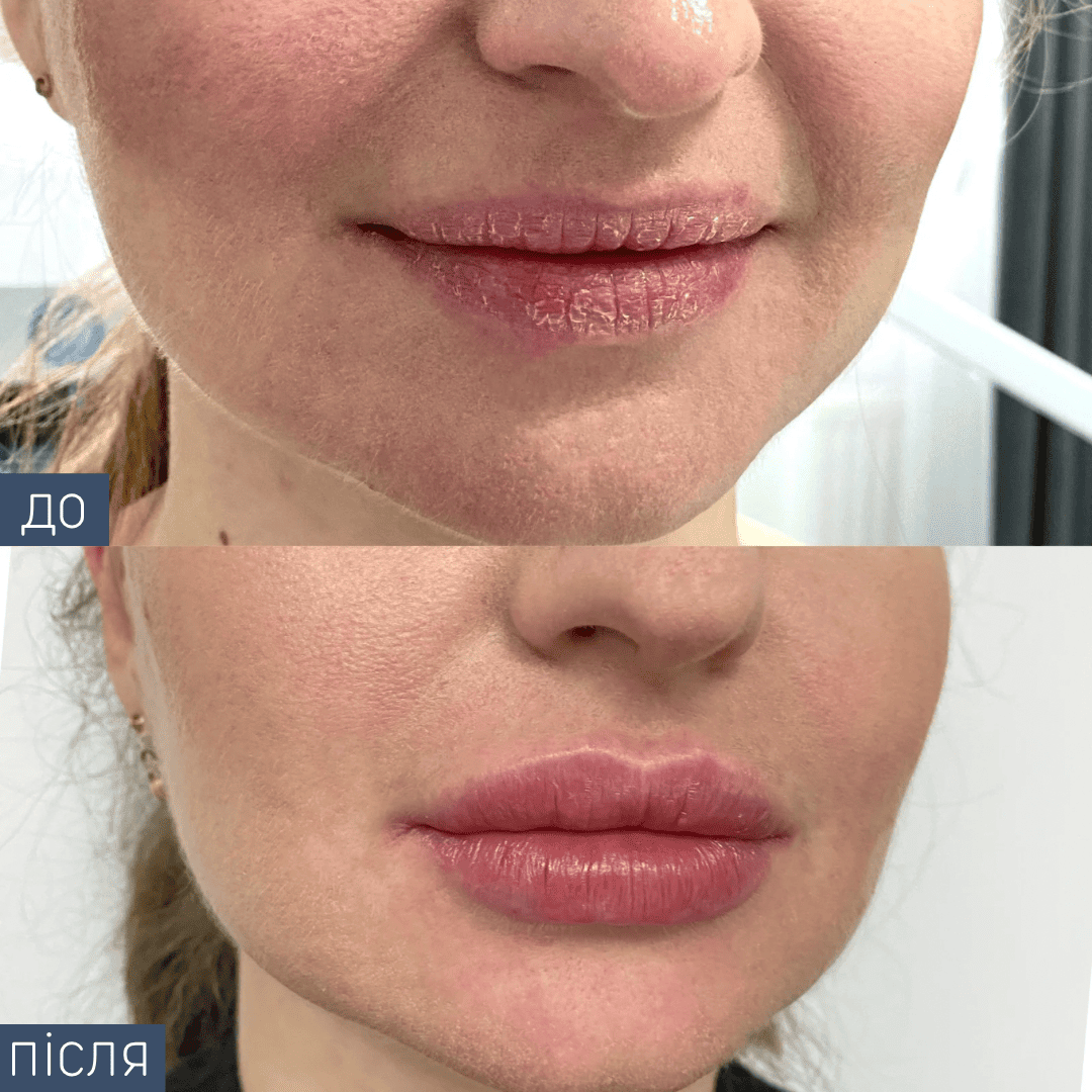 Процедура: Контурная пластика губ Препарат: Restylane Lidocaine 1 мл Врач: Александра Гугусь