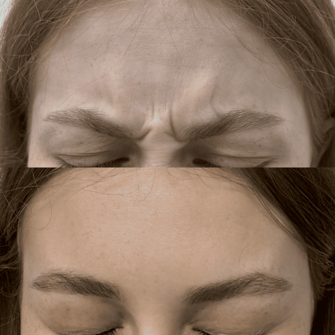 Процедура: Инъекции ботулинотерапии Препарат: Диспорт IPSEN Количество процедур: 1 Врач: Александра Гугусь