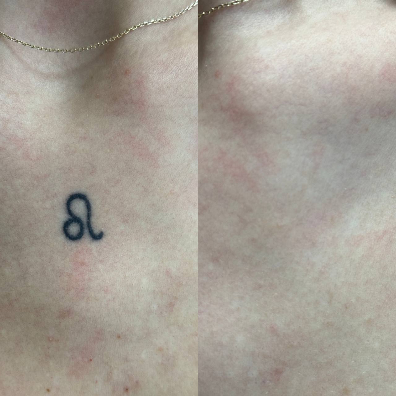 Процедура: Лазерне видалення тату Кількість процедур: 3 Лікар: Олександра Гугусь