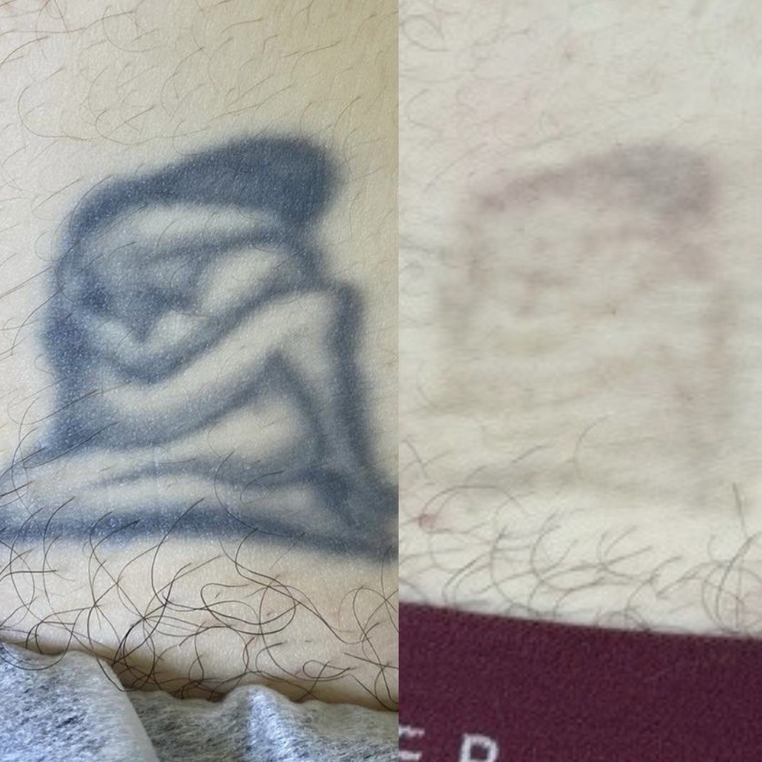 Процедура: Лазерне видалення тату Кількість процедур: 3 (результат проміжний) Лікар: Вікторія Збірко