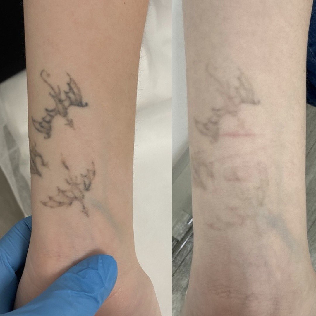 Процедура: Лазерне видалення тату Кількість процедур: 1 (результат проміжний) Лікар: Олександра Гугусь