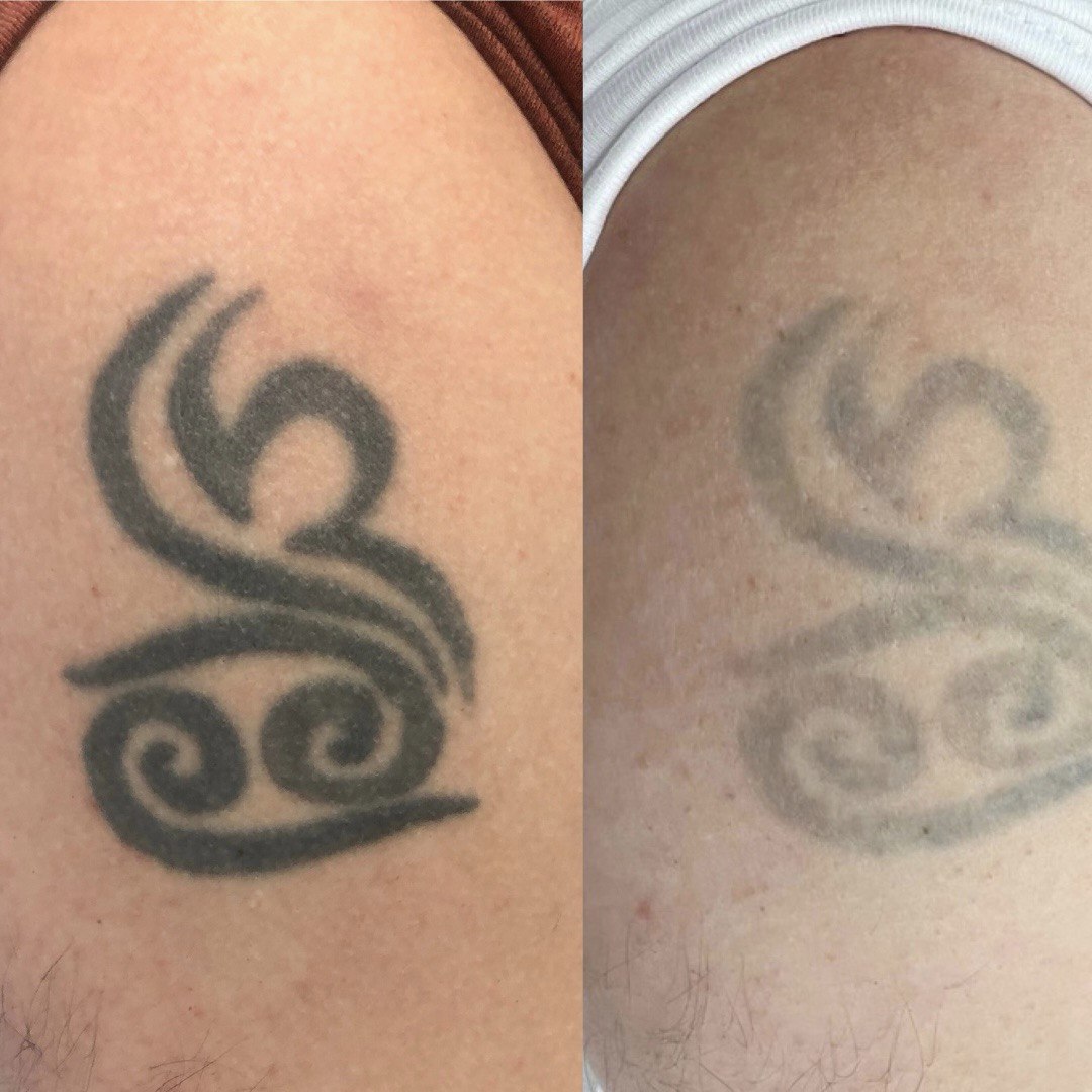 Процедура: Лазерне видалення тату Кількість процедур: 1 (результат проміжний) Лікар: Ольга Харко