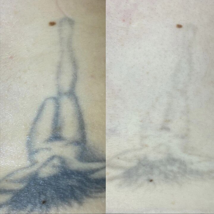 Процедура: Лазерне видалення тату Кількість процедур: 2 (результат проміжний) Лікар: Вікторія Збірко