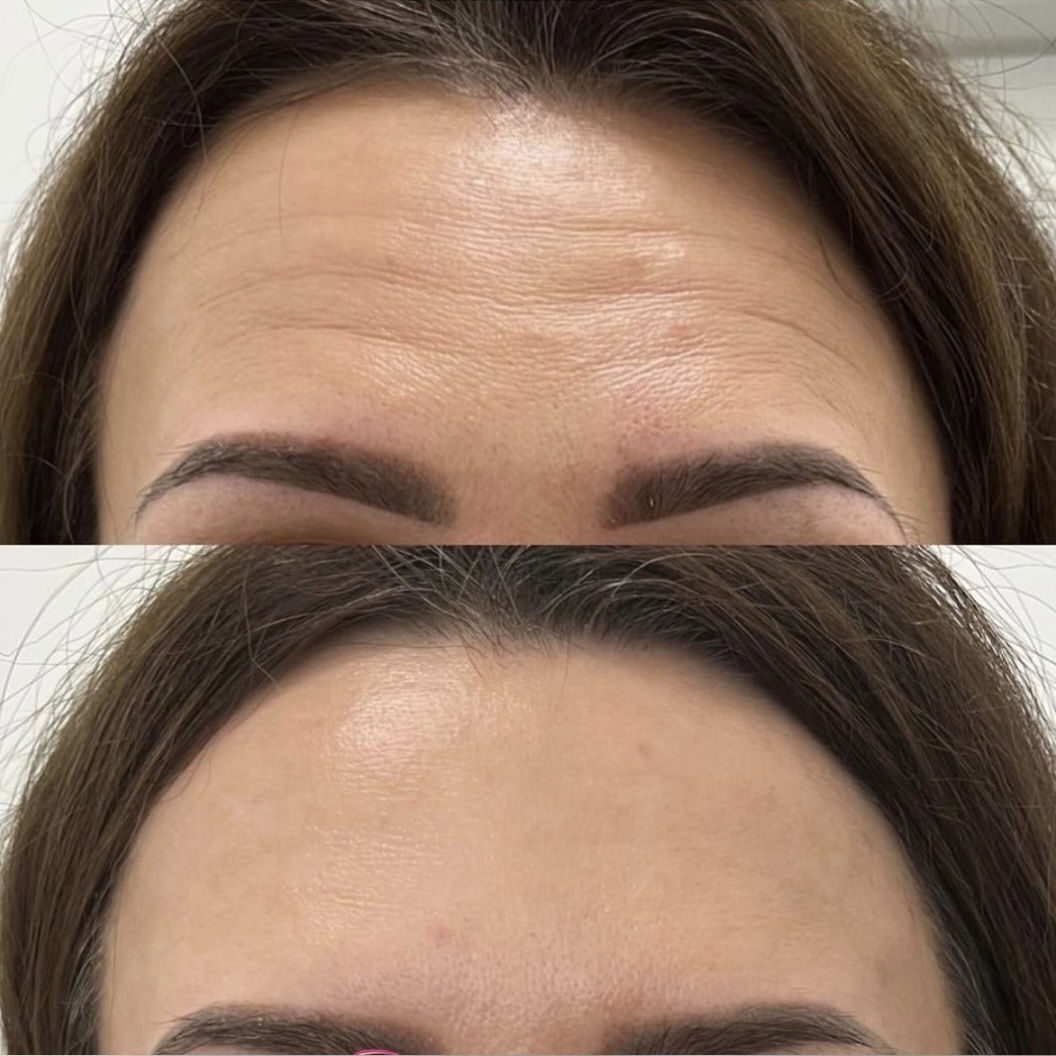 Процедура: Инъекции ботулинотерапии Препарат: Ботокс ALLERGAN Количество процедур: 1 Врач: Оксана Самотос