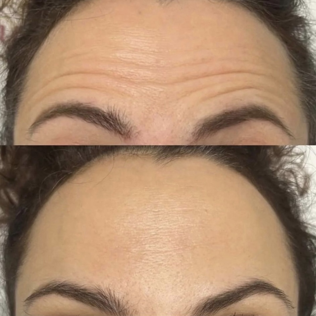 Процедура: Инъекции ботулинотерапии Препарат: Ботокс ALLERGAN Количество процедур: 1 Врач: Оксана Самотос