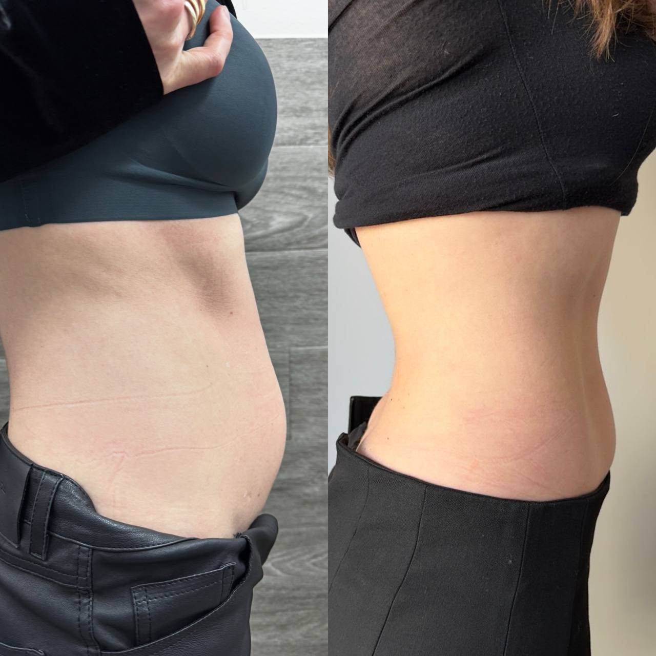 Ділянка: живіт Кількість процедур: 1