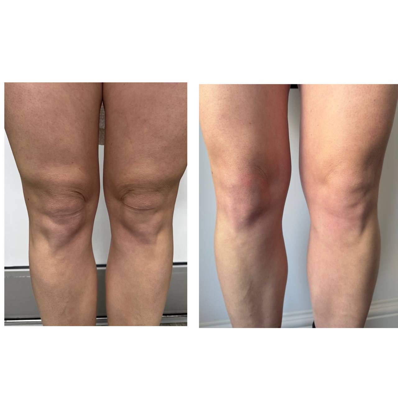 Ділянка: верхня частина колін Кількість процедур: 1