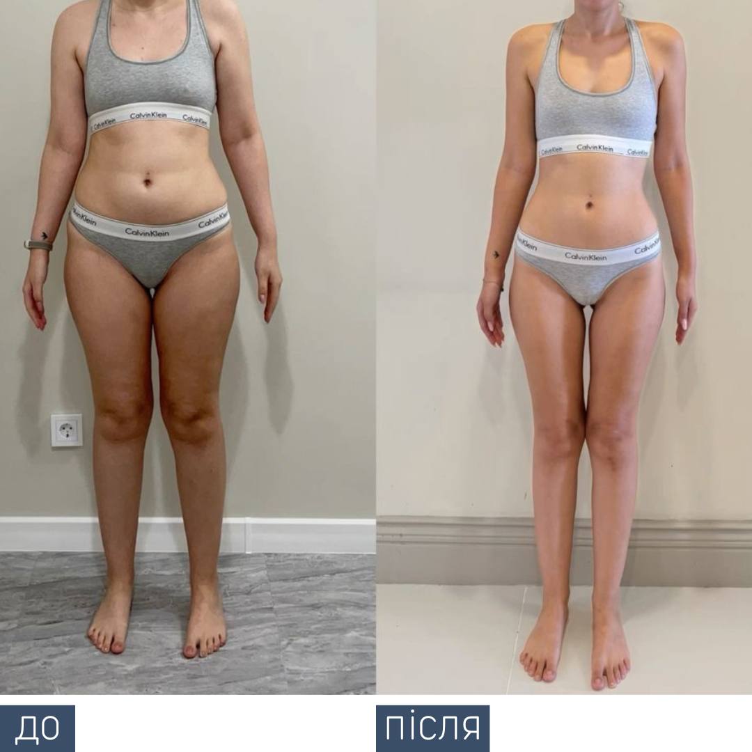 Процедура: консультація дієтолога + індивідуальний супровід