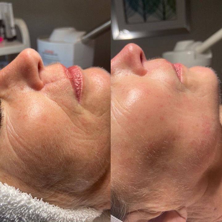 Процедура: микроигловой RF лифтинг VIVACE