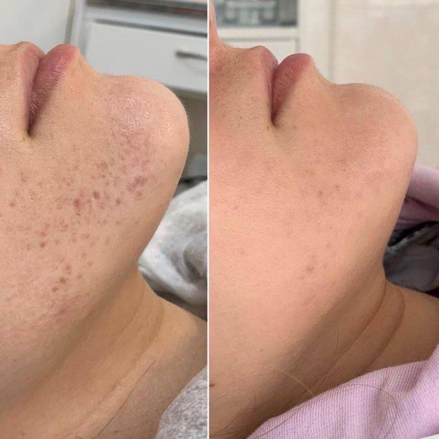 Процедура: микроигловой RF лифтинг VIVACE