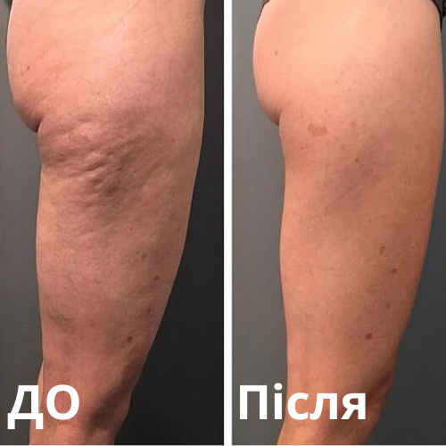 Ділянка: сідниці+ноги Кількість процедур: 5